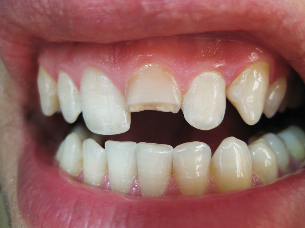 sonhar com dente quebrado