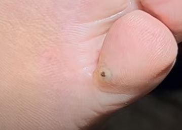 O que significa sonhar com bicho de pé?